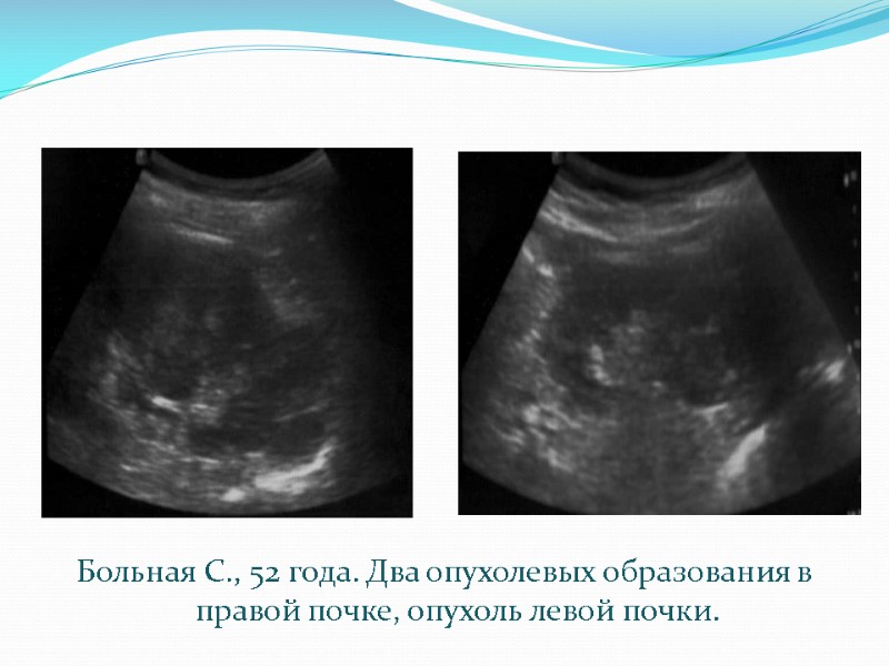 Больная С., 52 года. Два опухолевых образования в правой почке, опухоль левой почки.